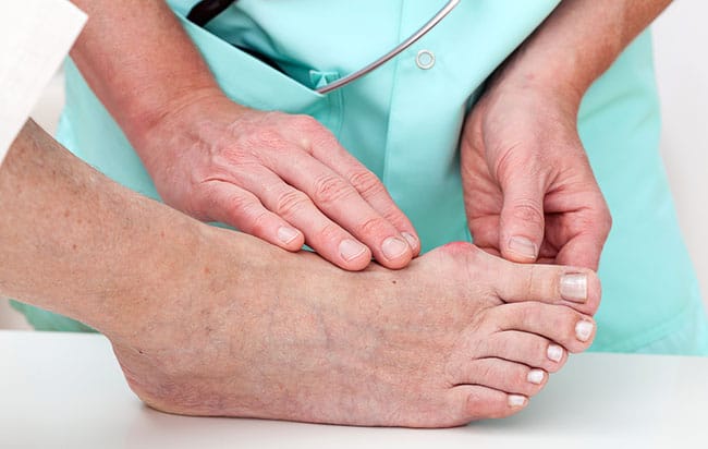 Bunions: Misconceptions Debunked